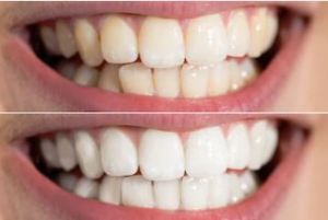 Before/After