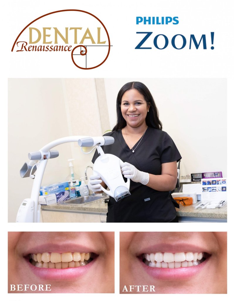 Zoom Whitening marketing material